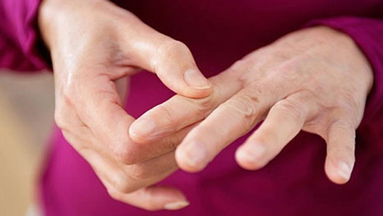 Artritis Reumatoidea - Rigidez