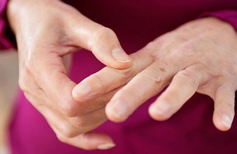 Artritis Reumatoidea - Rigidez