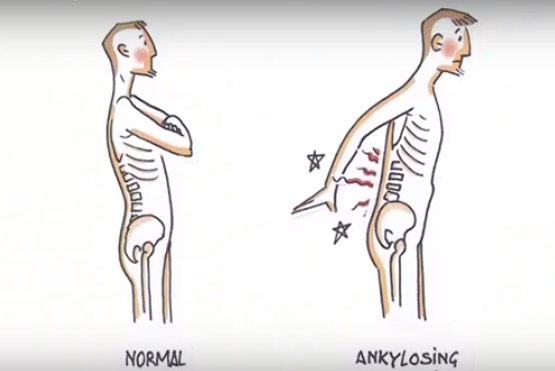 Conciencia de la Espondiloartritis Axial