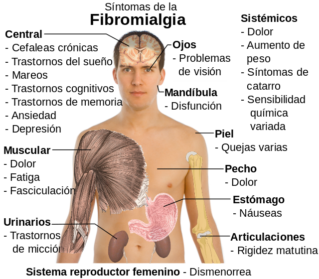 fibromialgia todo lo que sabemos hasta ahora 01