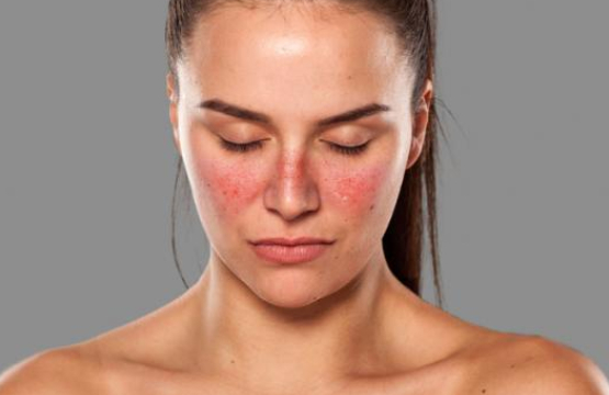 Lupus