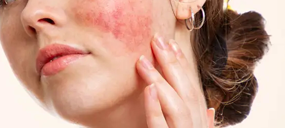Lupus