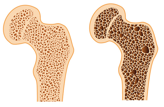 Osteoporosis